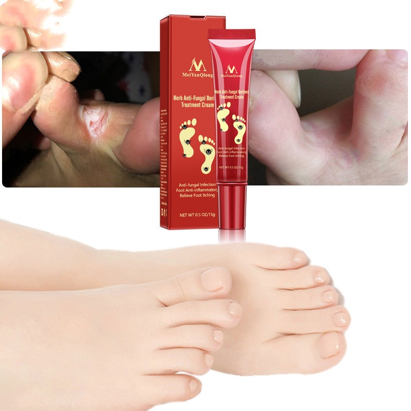 Herb Anti-Fungal Beriberi Treatment Cream