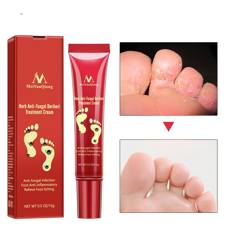 Herb Anti-Fungal Beriberi Treatment Cream