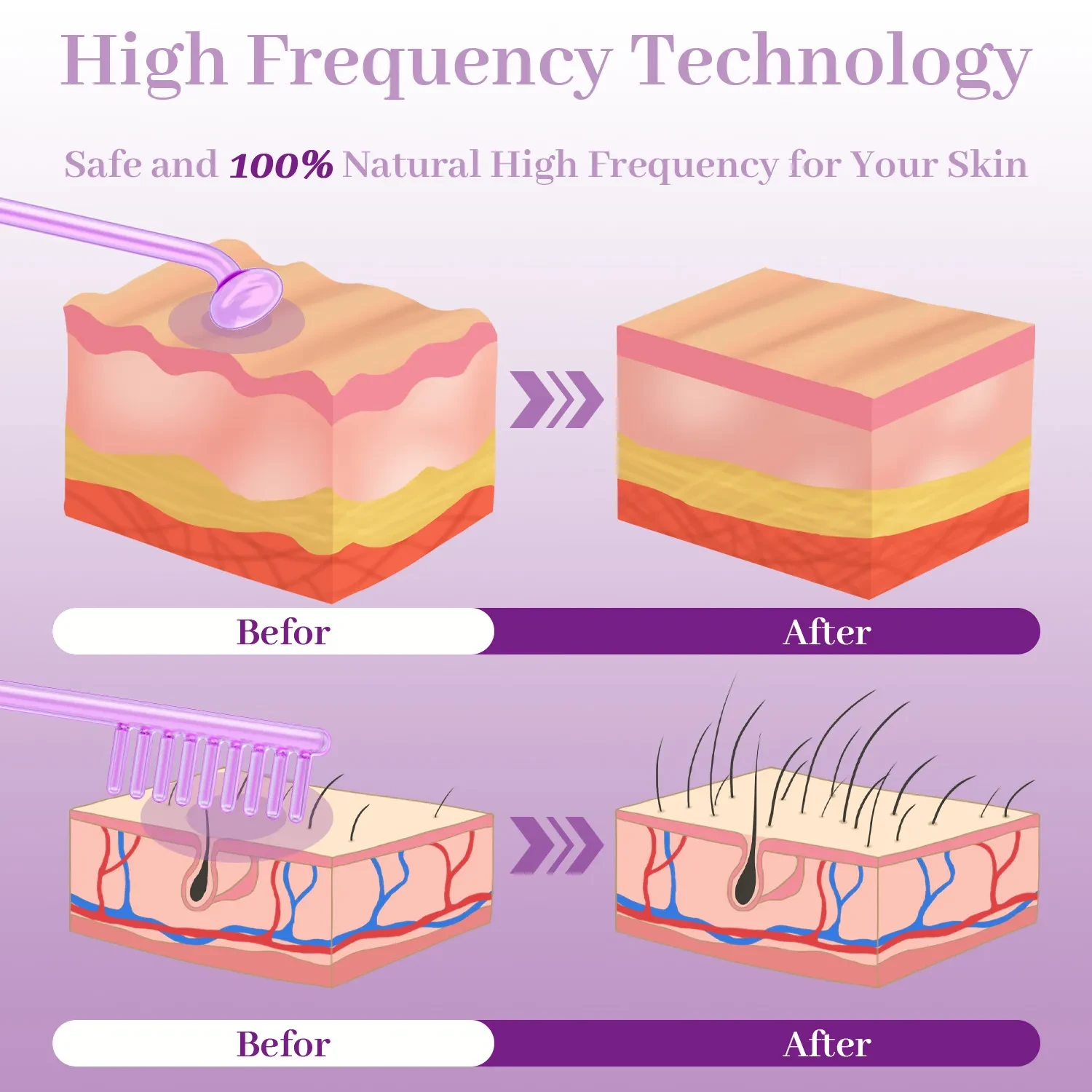 Electrotherapy Rod High Frequency