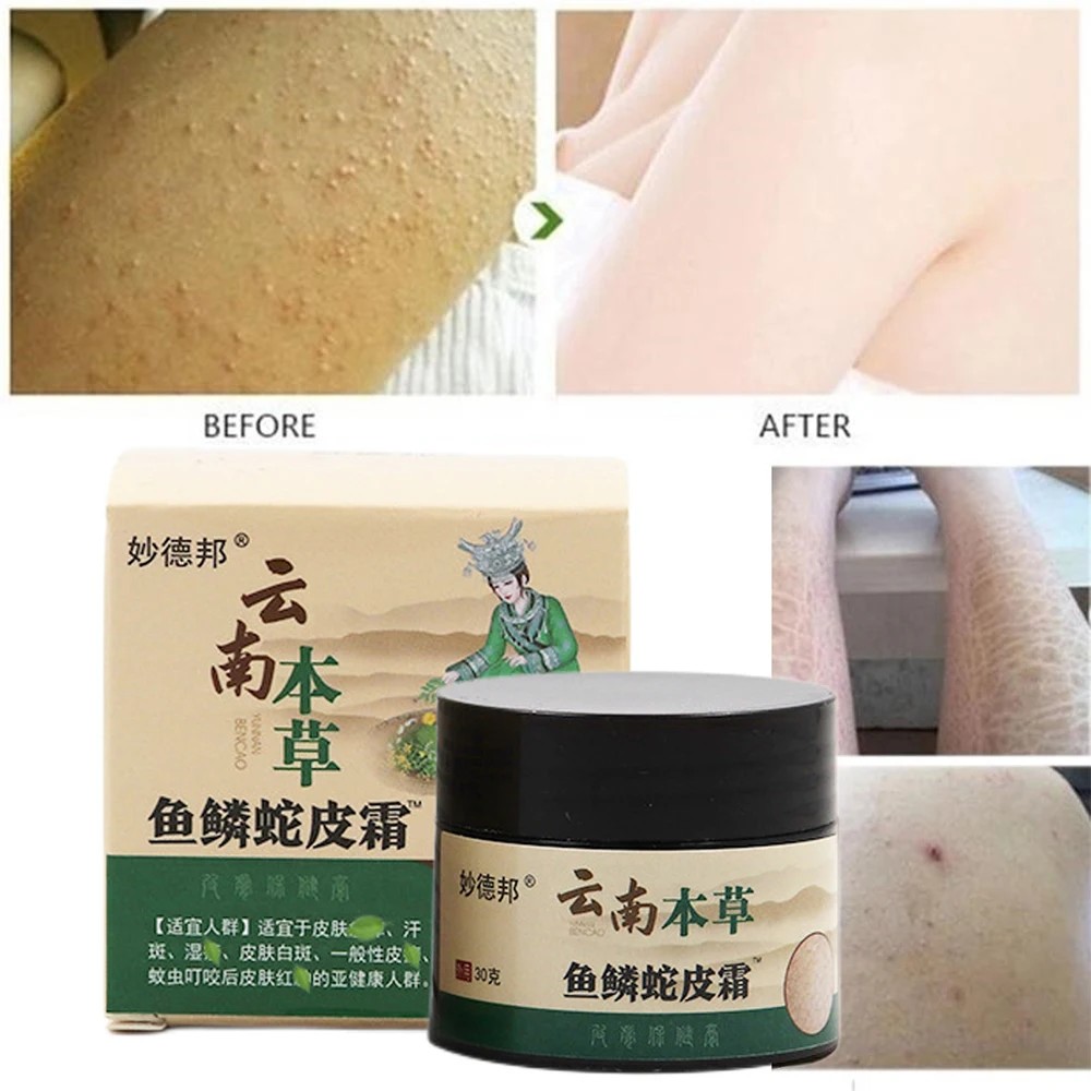 Chicken Skin Repair Cream - Keratosis Pilaris Treatment and Pore Smoothing