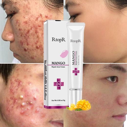 RtopR mango acne cream