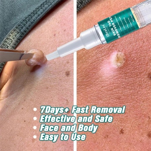 Wart Flat Especially AcutenessKe You Cream Smooth Liquid