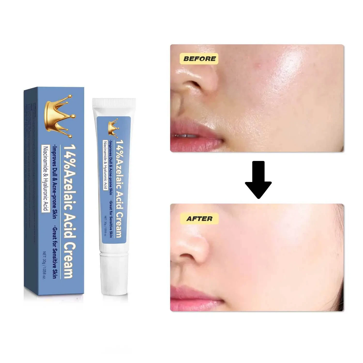 Azelaic Acid Cream